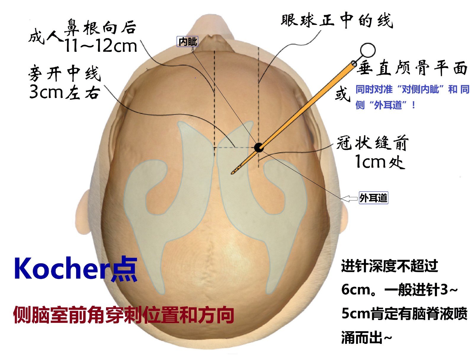 图3-4 kocher点.jpg