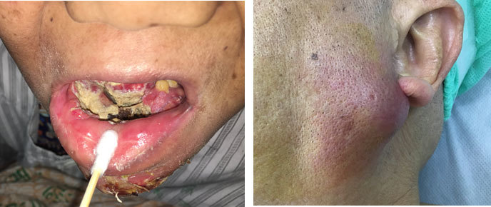 早期口腔癌或腮腺癌单纯手术治疗的治愈率高达70-80%以上,而中晚期虽