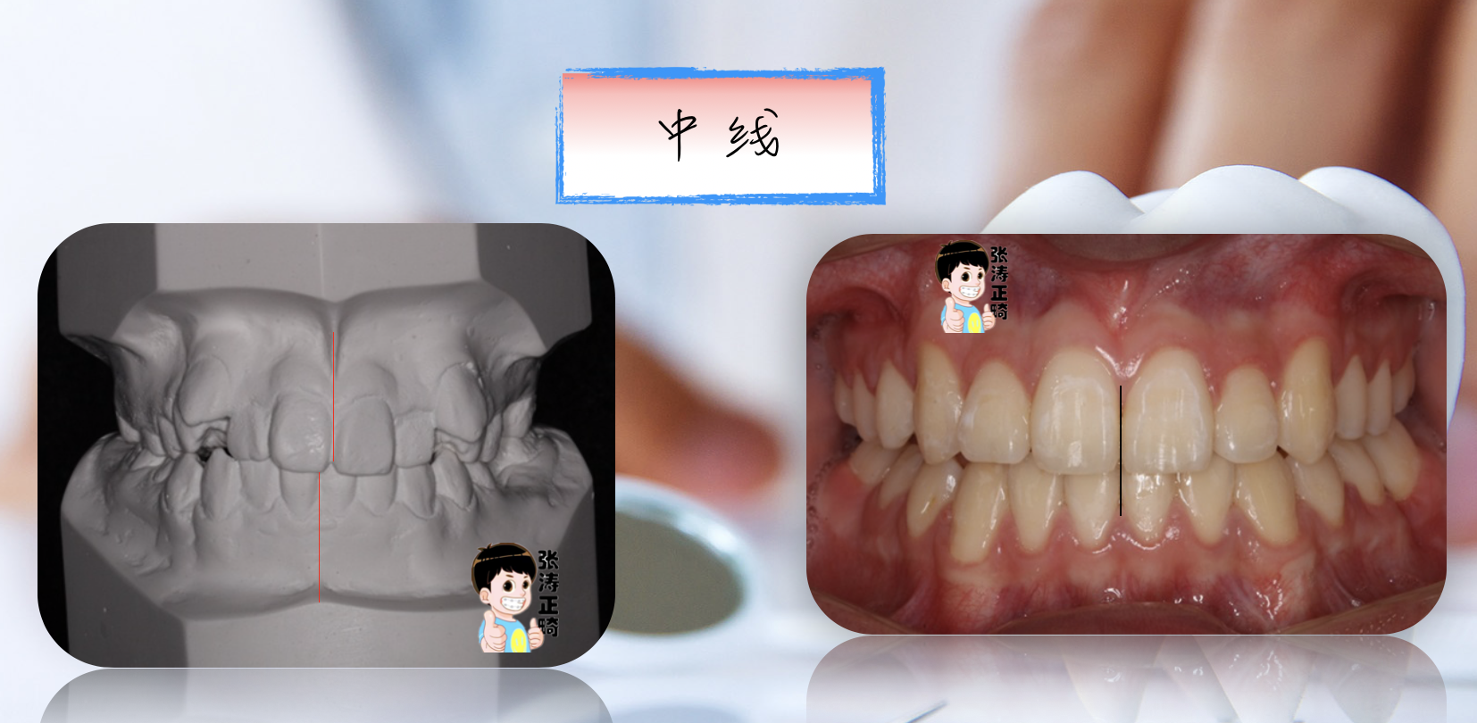 齲齒牙列不齊