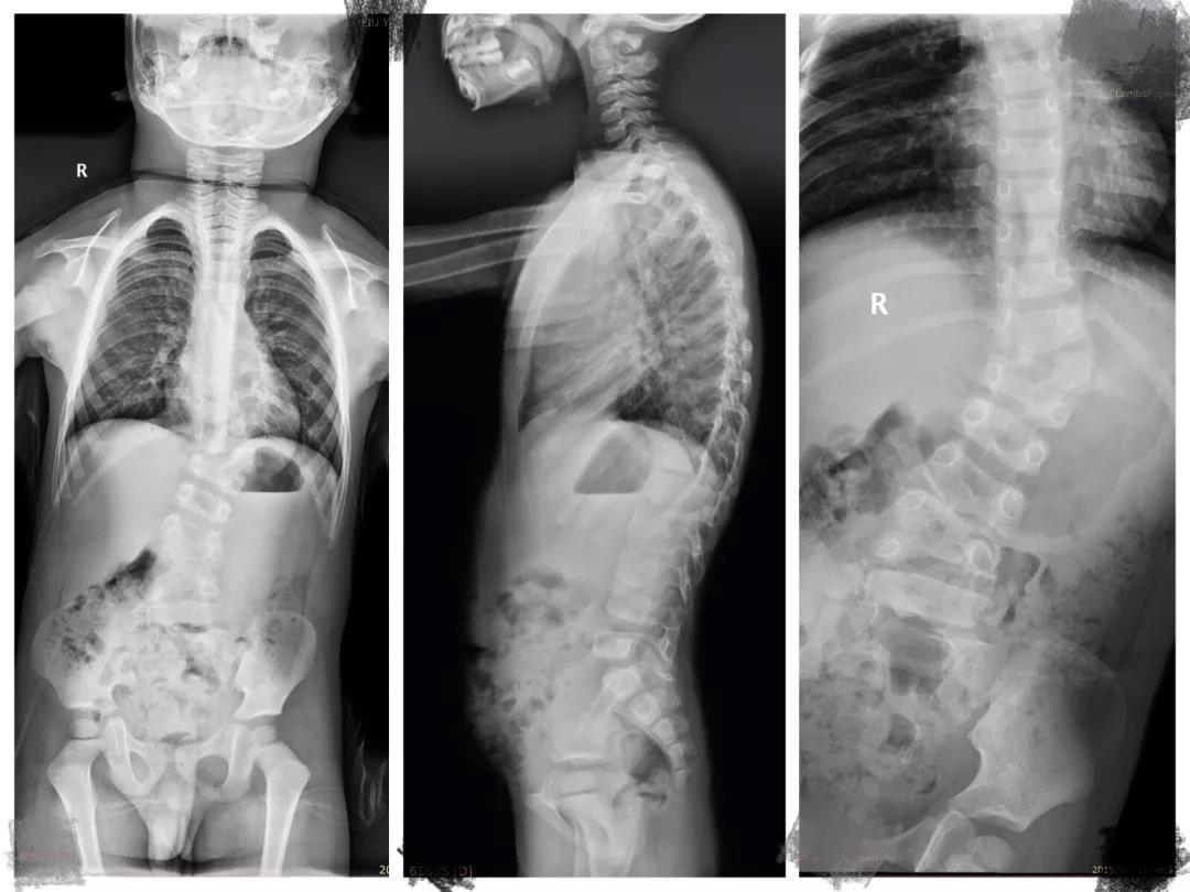"孩子是先天性脊柱侧弯,考虑到他的年龄,身体发育等综合情况,我们建议