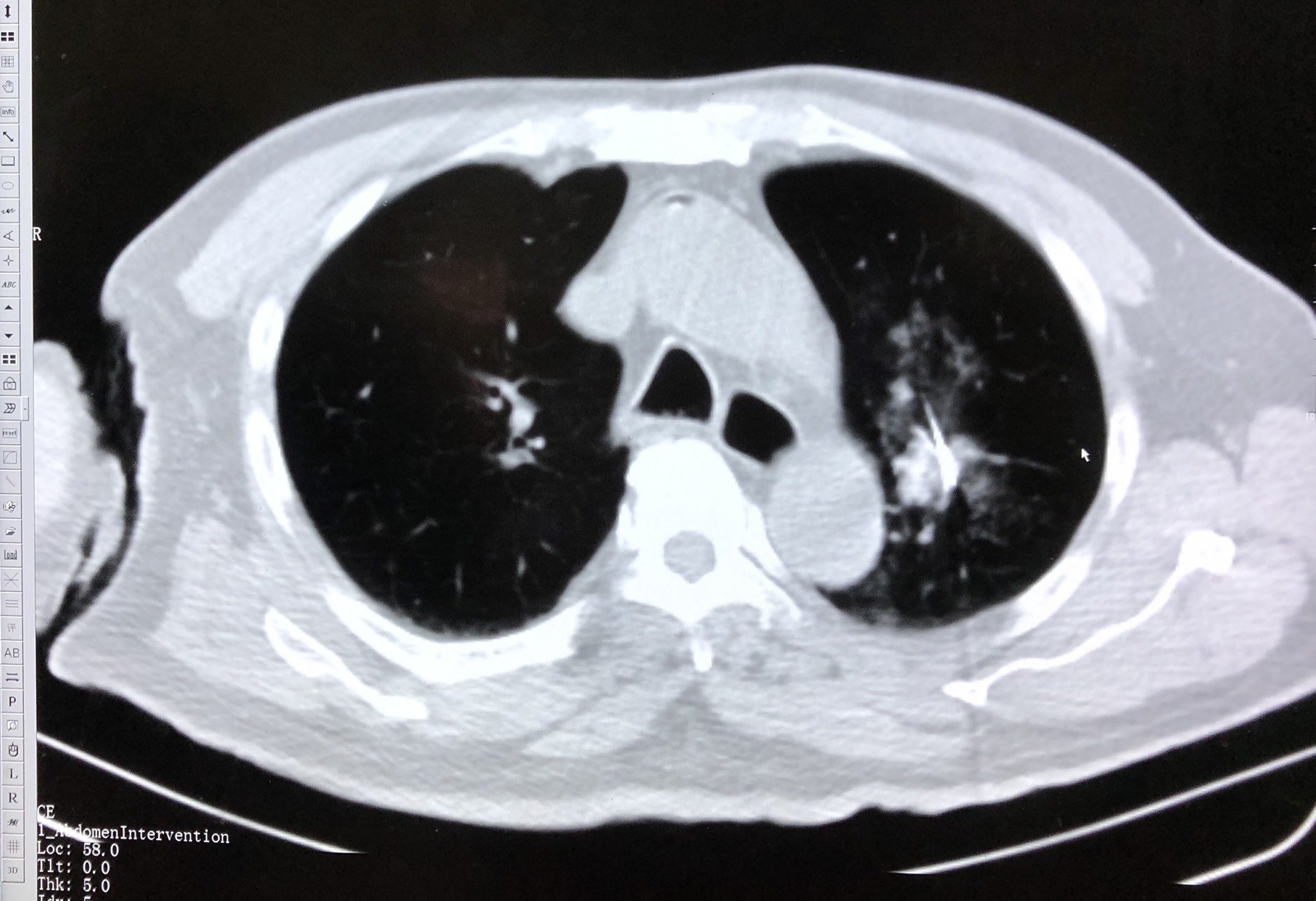 肺癌微波消融案例分享