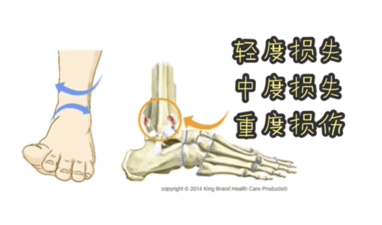 对于这个高位踝关节扭伤该如何治疗,当然还是要根据受伤的严重程度来