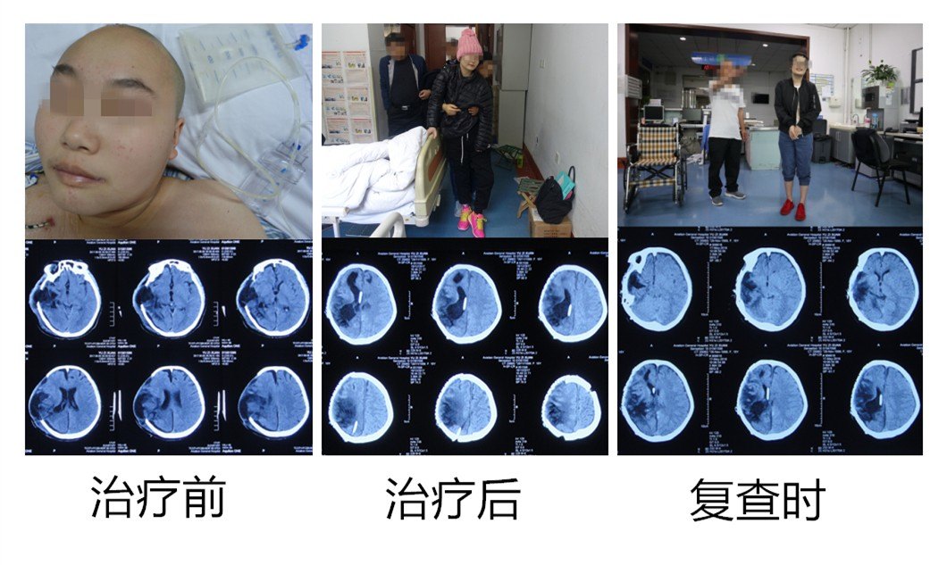 (3)动脉瘤术后(4)脑肿瘤术后三,分流术后并发症(1)反复分流失败,分流