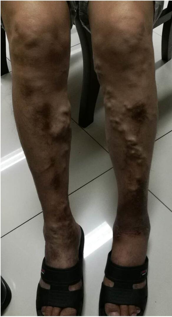 肥胖患者静脉曲张,小腿直接打针硬化,大腿插管硬化治疗 - 好大夫在线