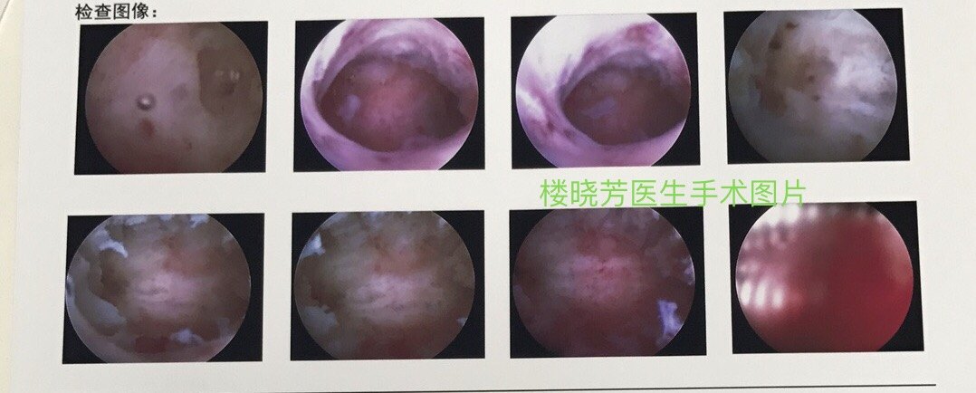 宮腔鏡_病因_症狀_治療方法_相關疾病_手術_治療介紹 - 好大夫在線