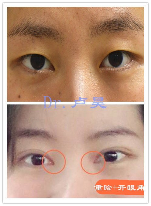 重睑及内眦.jpg