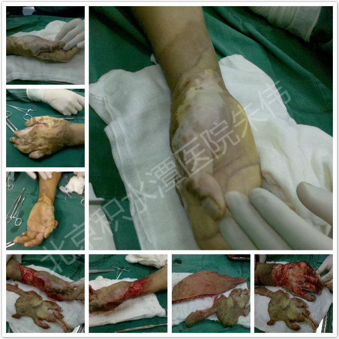 皮瓣移植术后护理及注意事项