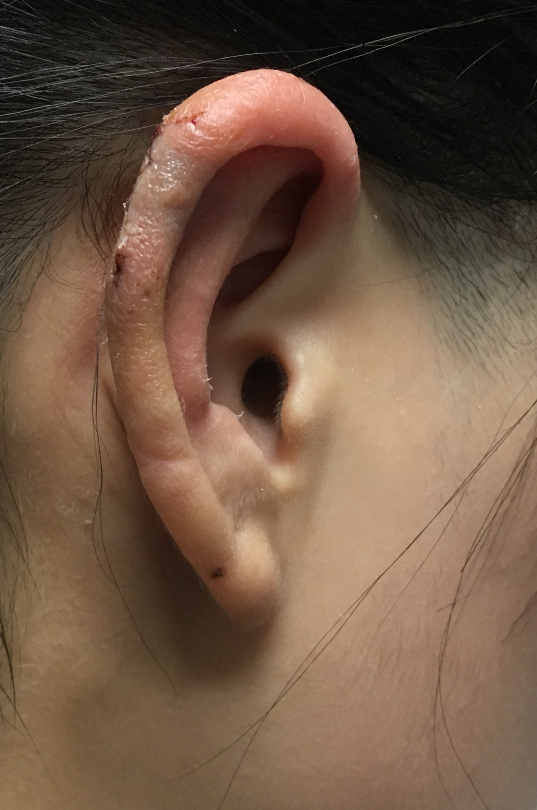 耳朵瘢痕疙瘩照片图片