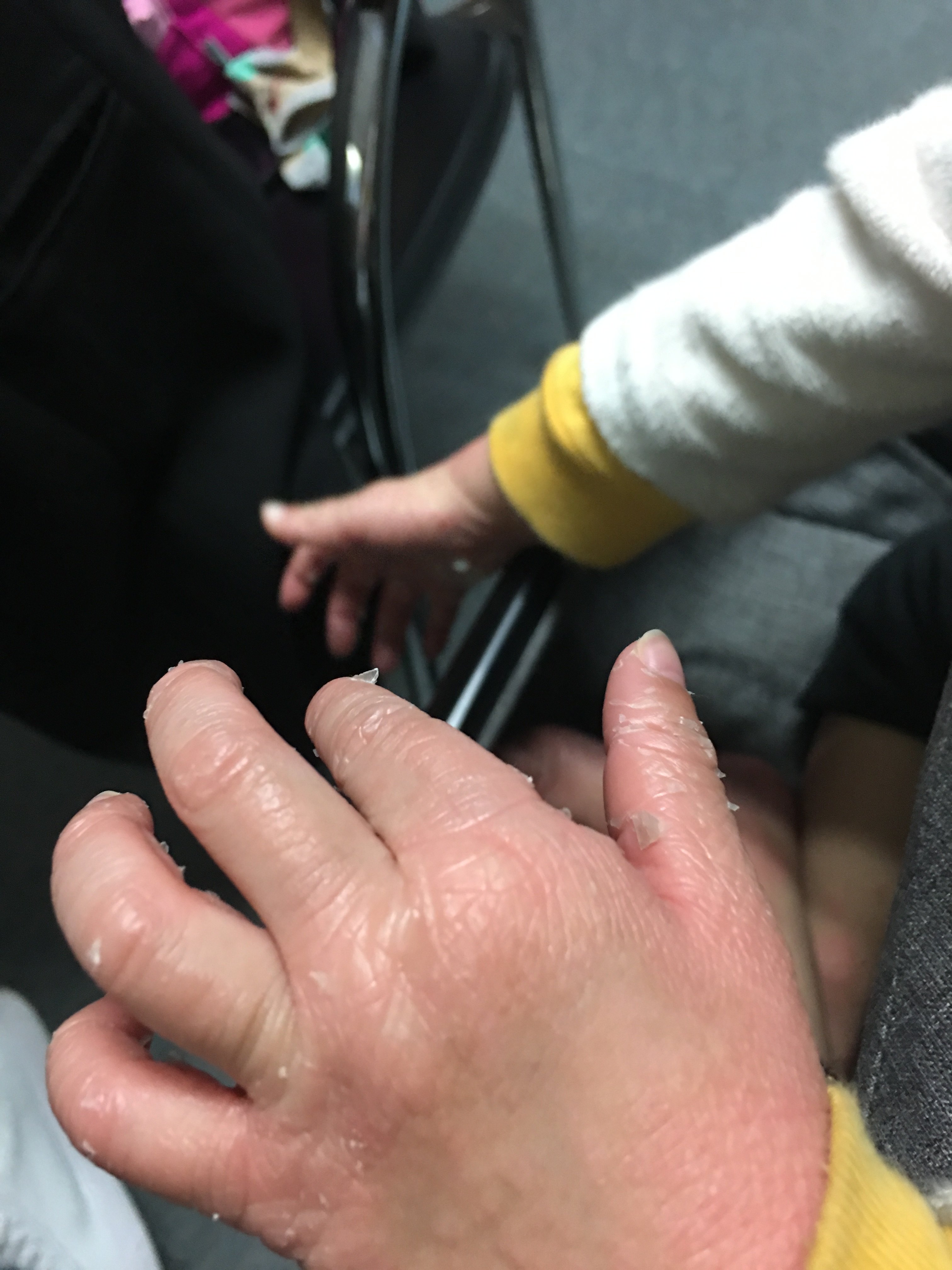 毛发红糠疹成因,诊断,治疗及预后_皮肤病_皮肤病相关疾病 - 好大夫