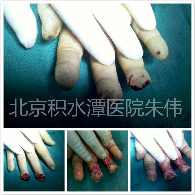 皮瓣移植术后护理及注意事项_断指再植_手术_治疗介绍 - 好大夫在线