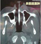 左前庭大腺囊肿图片图片