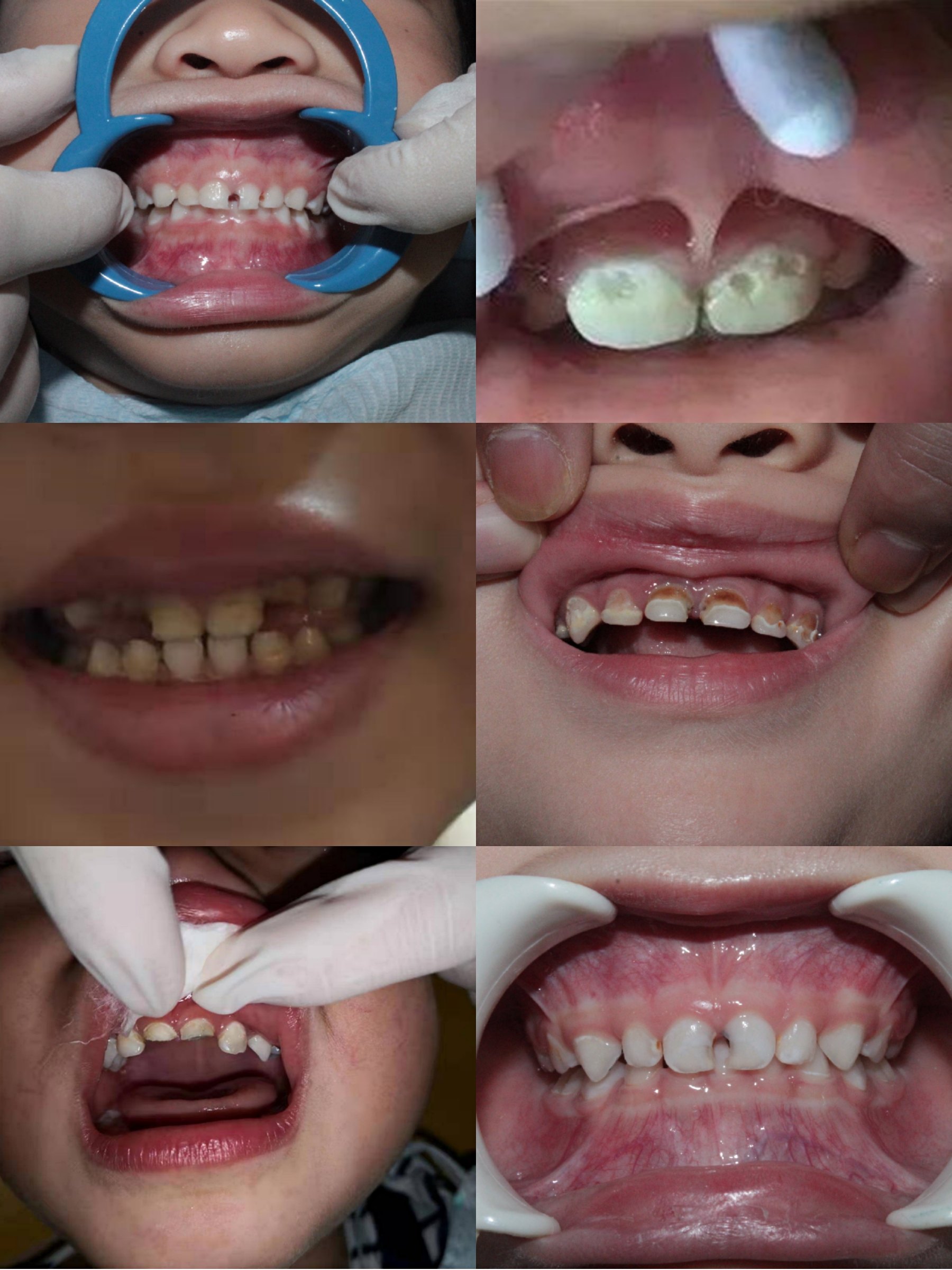 乳前牙龋齿治疗