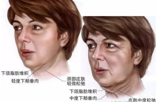 怎样改善面部松弛 xIYBAFwTIO-AS3JmAALJT88wZGA376.png?_ms_=7ce7