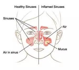 儿童鼻窦炎.jpg