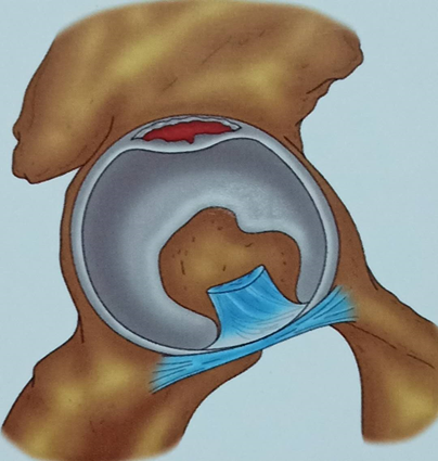髋部盂唇图片