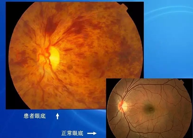 眼底病检查与病例分析 