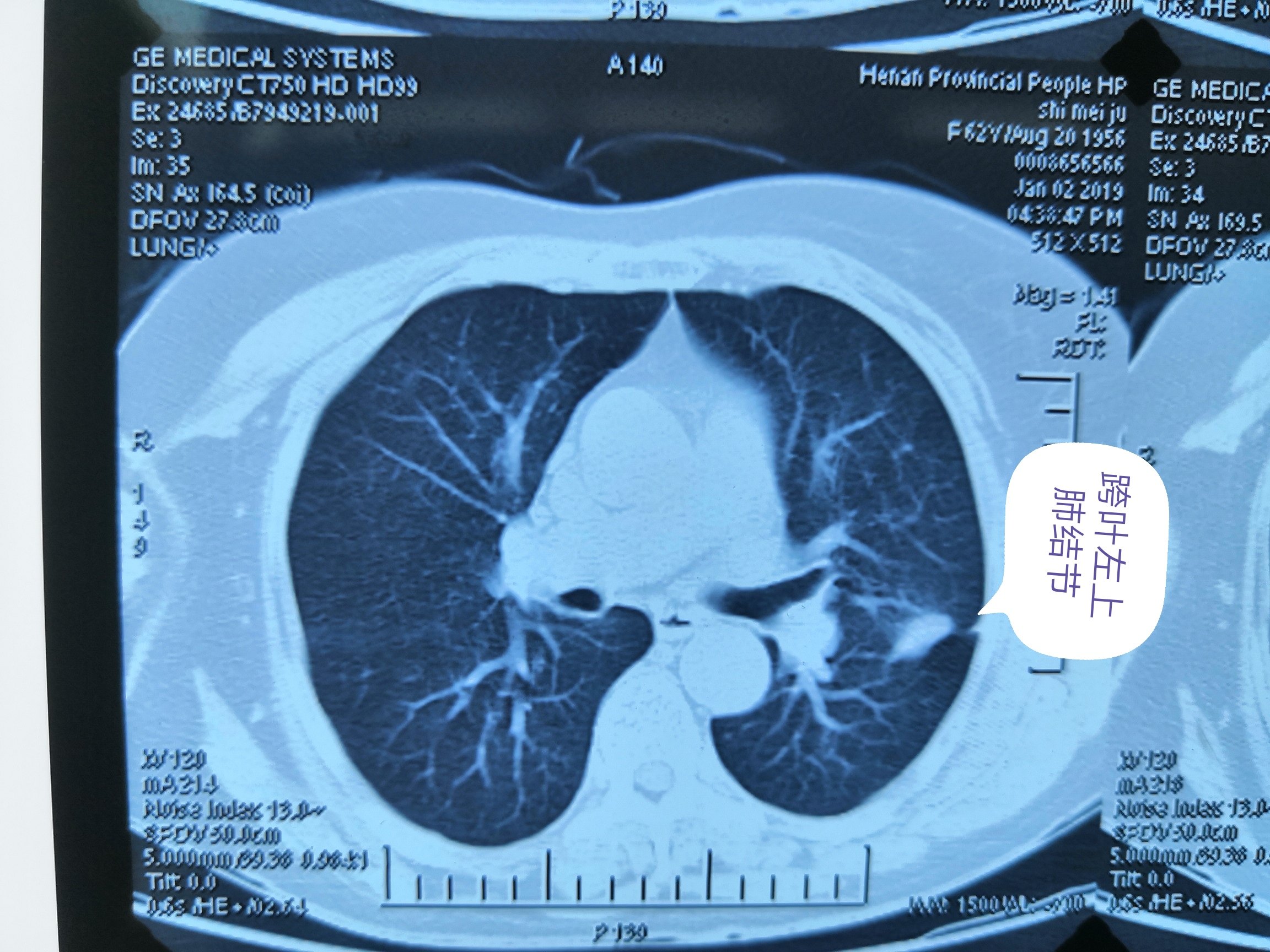 提示腺癌,行胸腔镜下左上肺叶加左下肺下叶背段切除纵隔淋巴结清扫