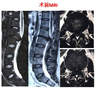 腰1/2棘突壓痛( ),叩壓痛( ),雙下肢後側及鞍區麻木,腰椎屈伸,側屈