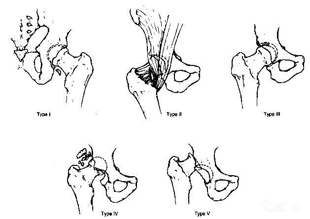 合并骨折治  疗1型髋关节脱位可手法复位allis最好在伤后24小时内复位