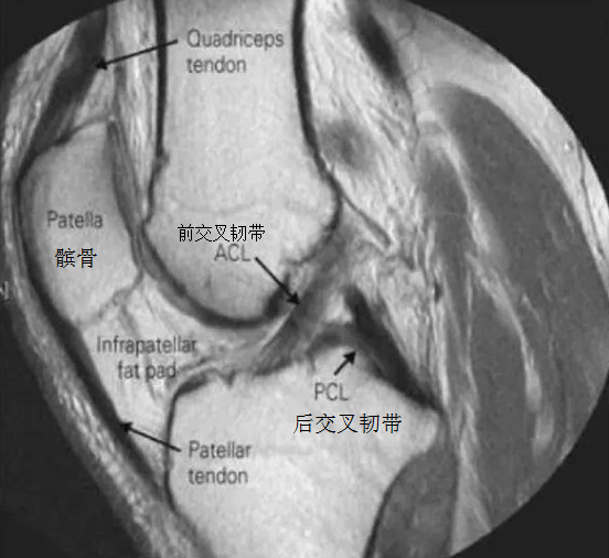 磁共振膝盖片子详解图图片