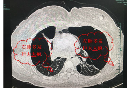 两侧肺内长有葫芦样的巨大肺大疱 