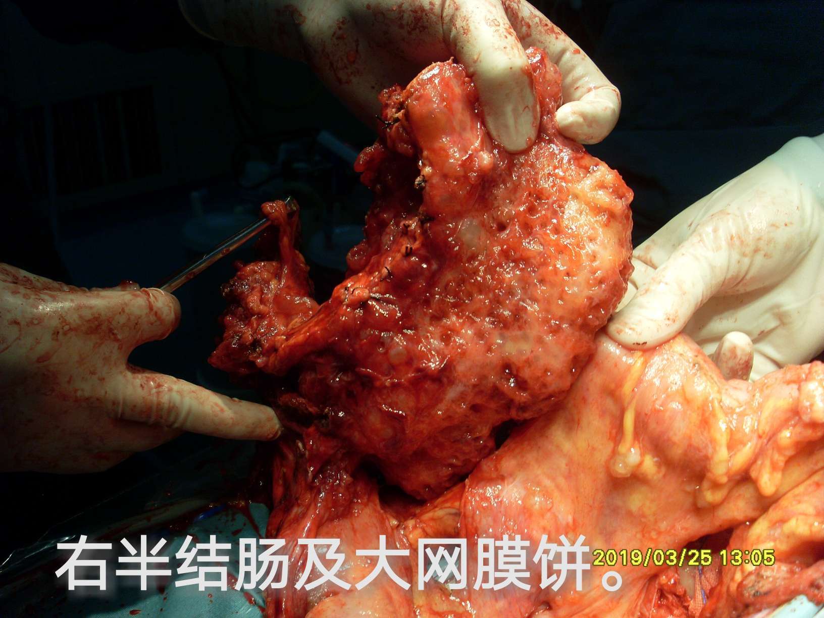 右侧附件,阴道残端,直肠及部分乙状结肠,右半结肠 全部大网膜,右膈肌