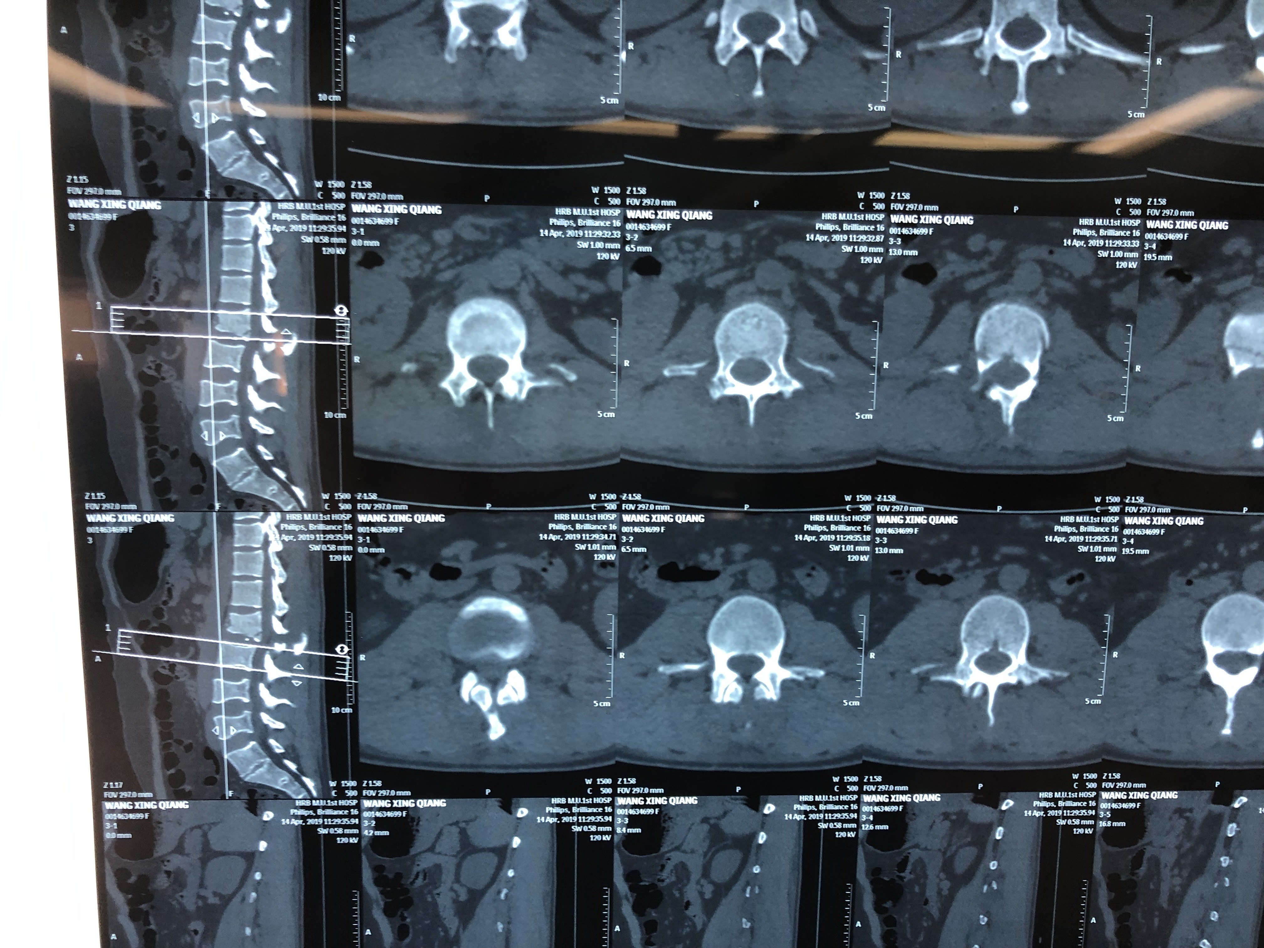 腰椎骨折x光片图片