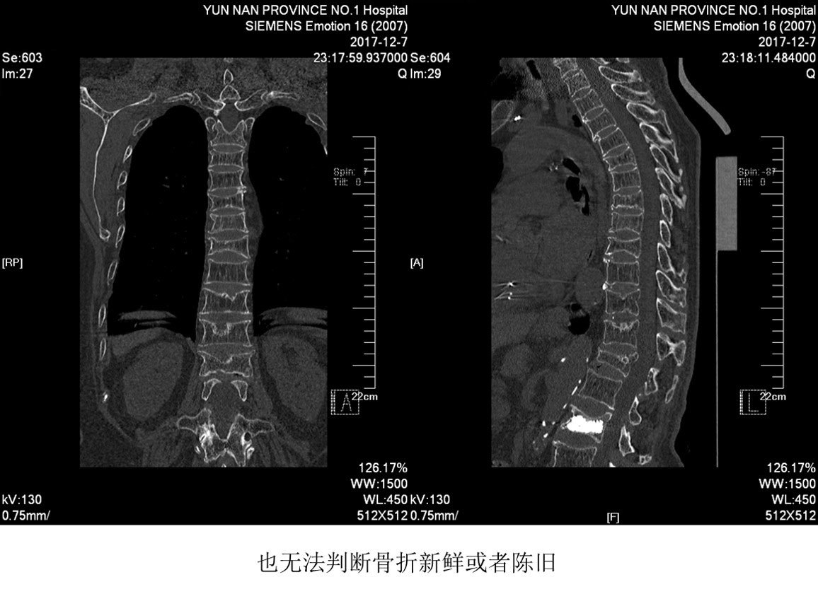 Spect核素骨显像在骨质疏松椎体压缩骨折中的应用 1 骨折 骨折检查