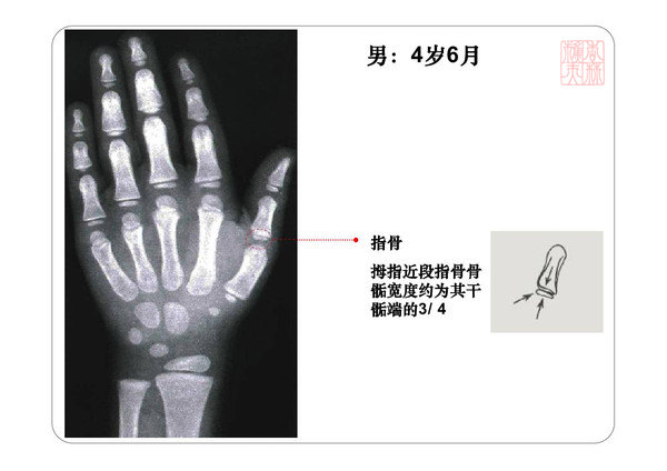 骨齡圖譜身高測試