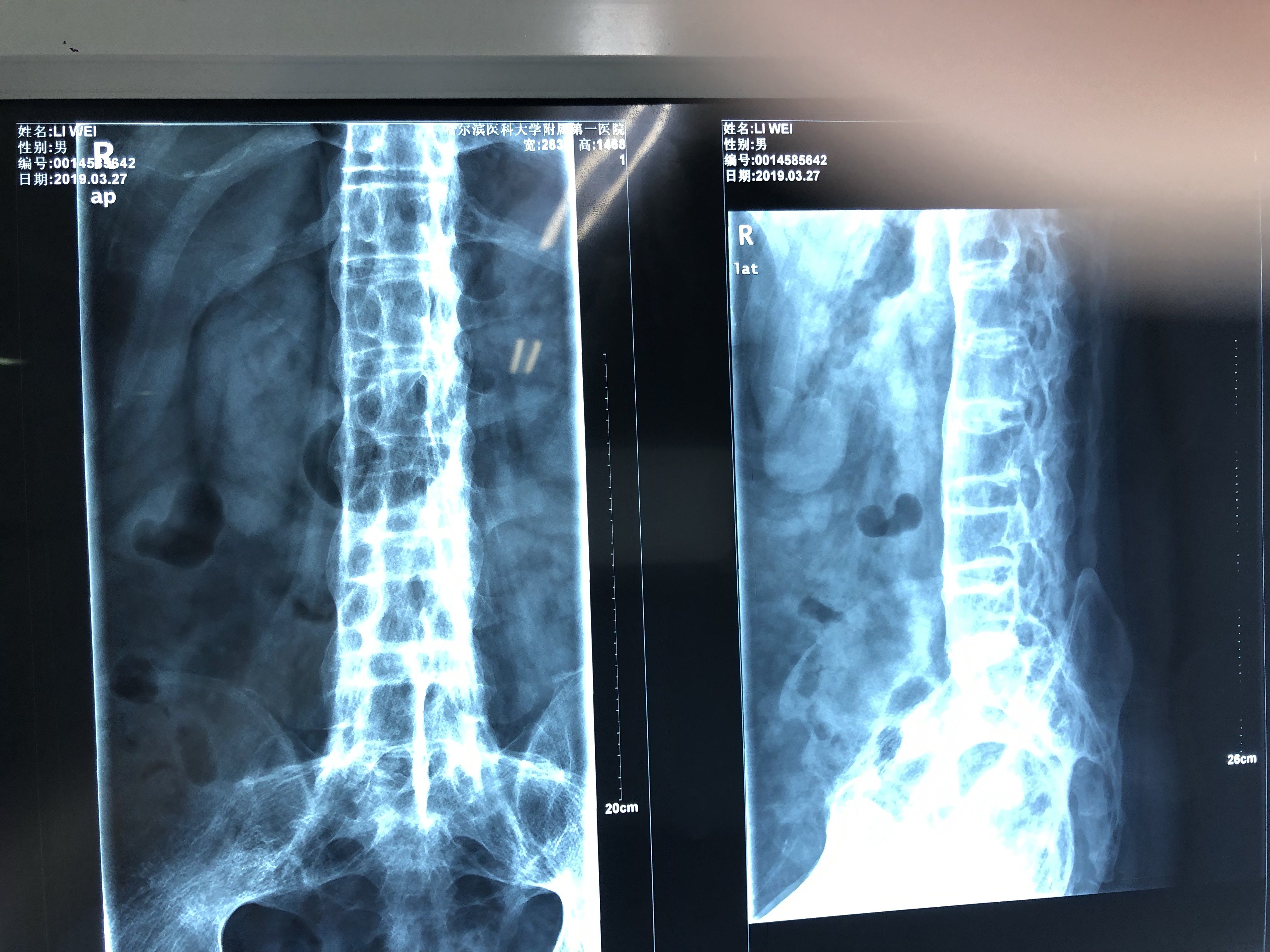 强直性脊柱炎患者图片图片