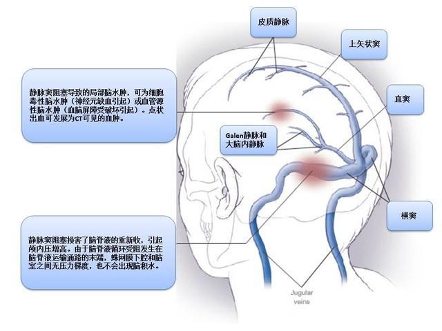 儿童脑血管疾病,颅内静脉窦血栓的危险因素及治疗