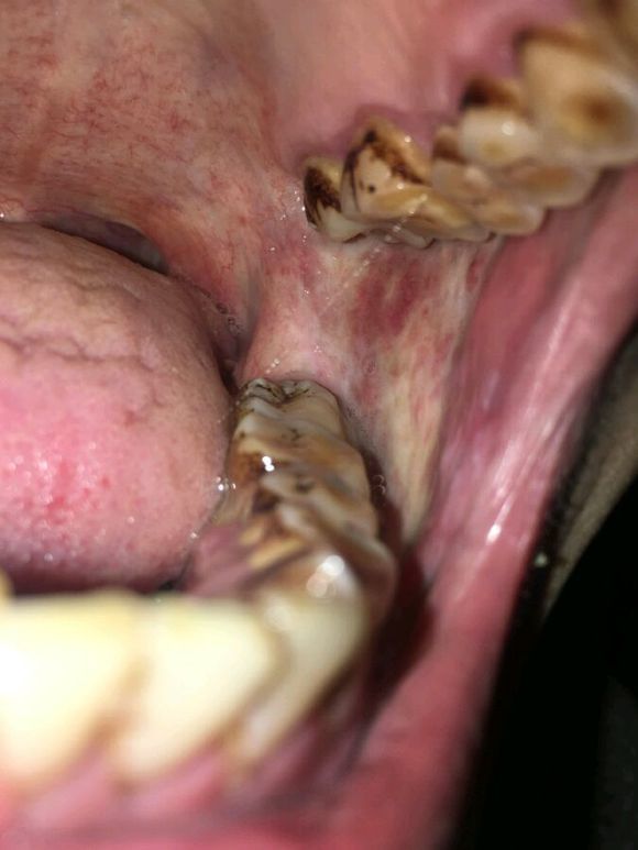 口腔癌的照片图片