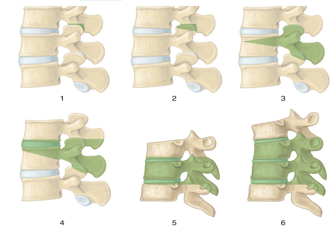 脊柱畸形的6级截骨(绿色代表截骨区域)