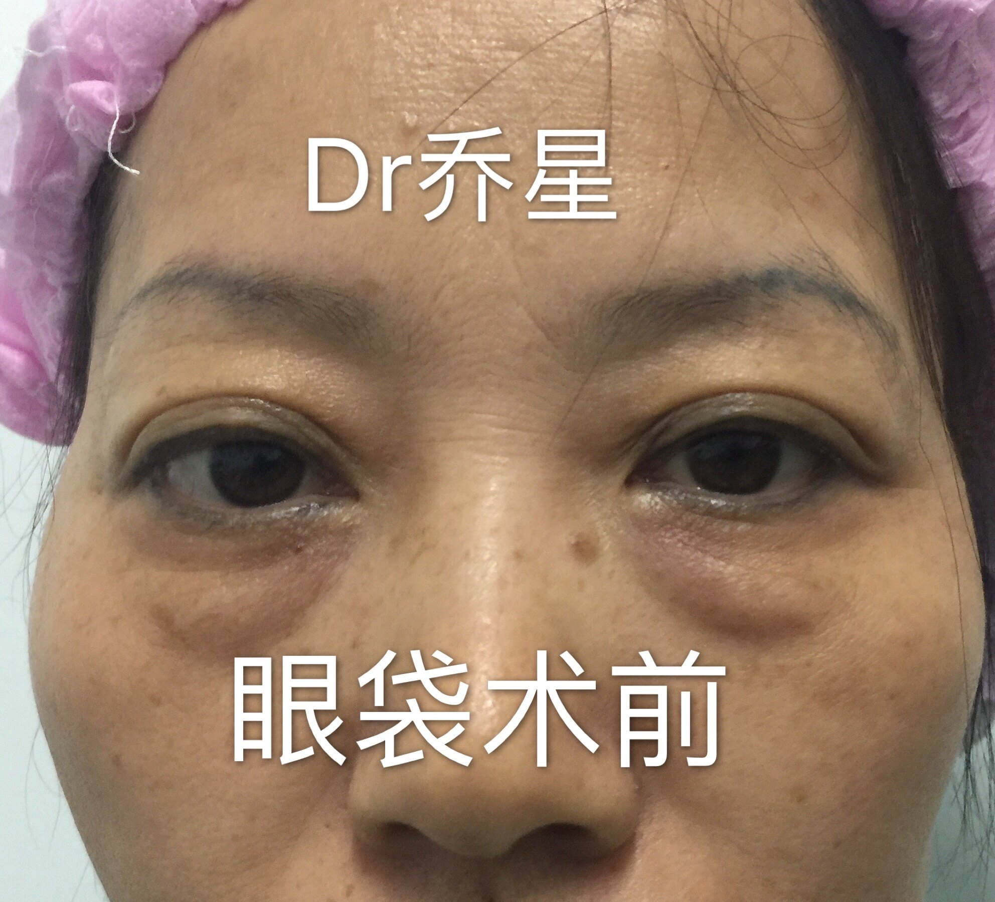 典型案例(眼袋) - 好大夫在线