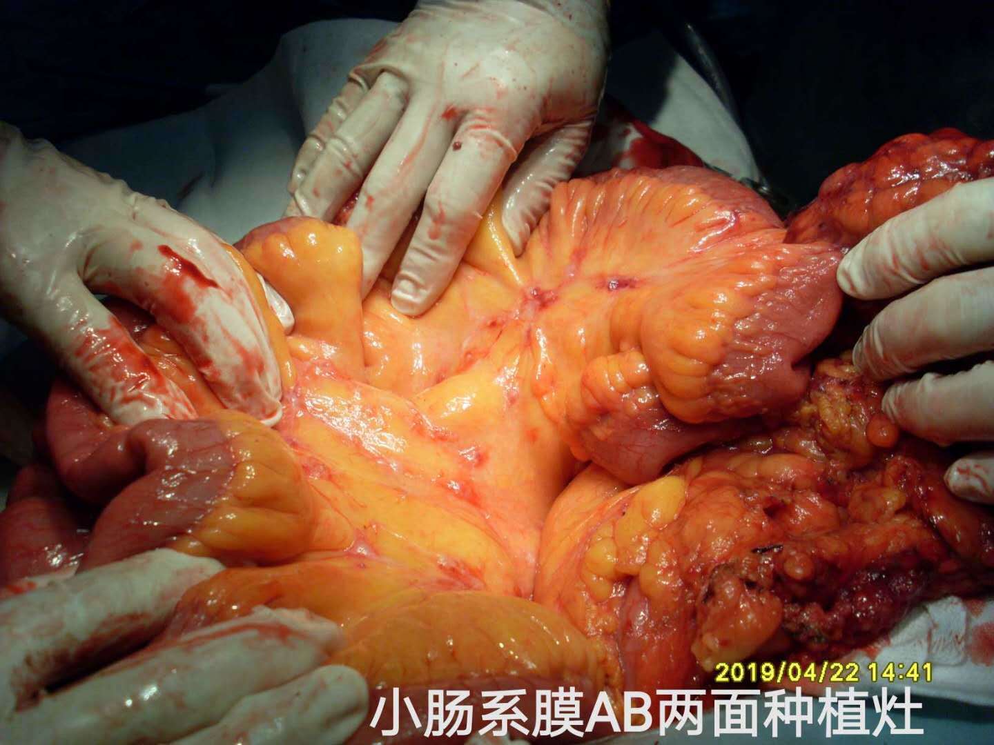 病例49--右下腹囊肿伴pm腹腔镜探查为高级别pmp晚期 - 好大夫在线