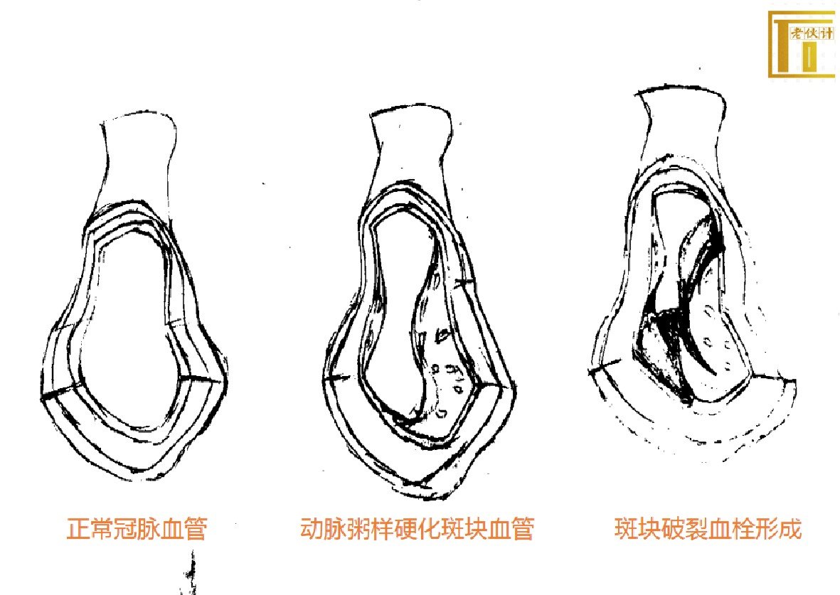 动粥斑块血栓