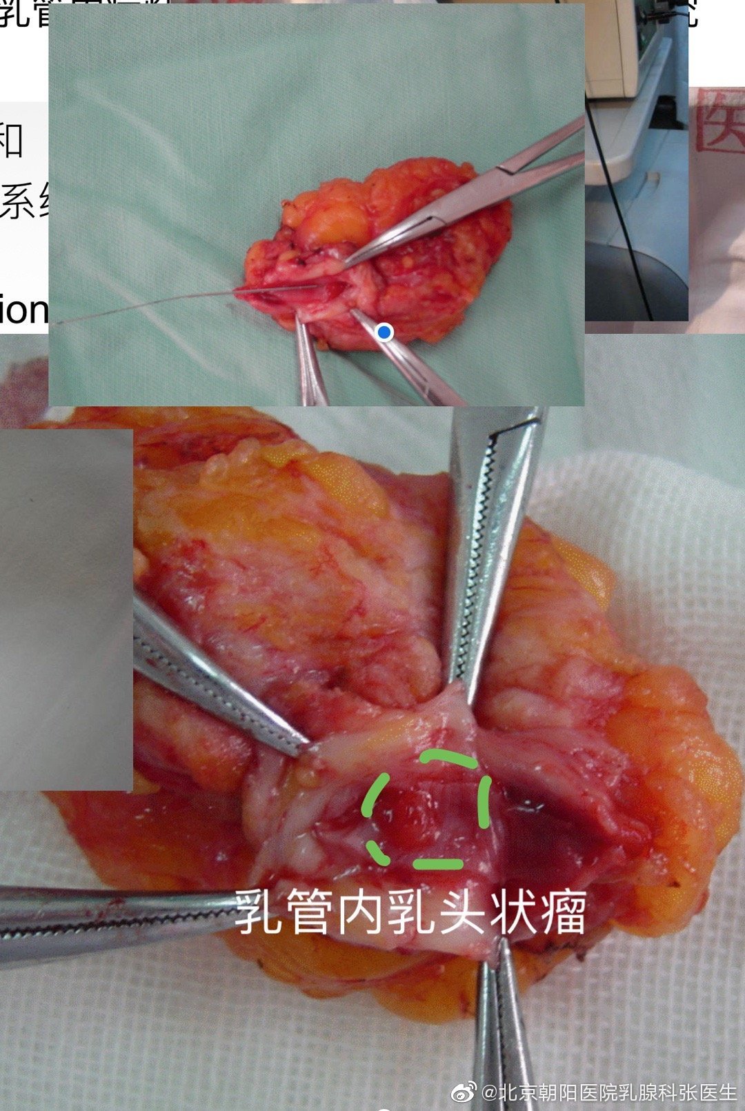 食管乳头状瘤内镜切除图片