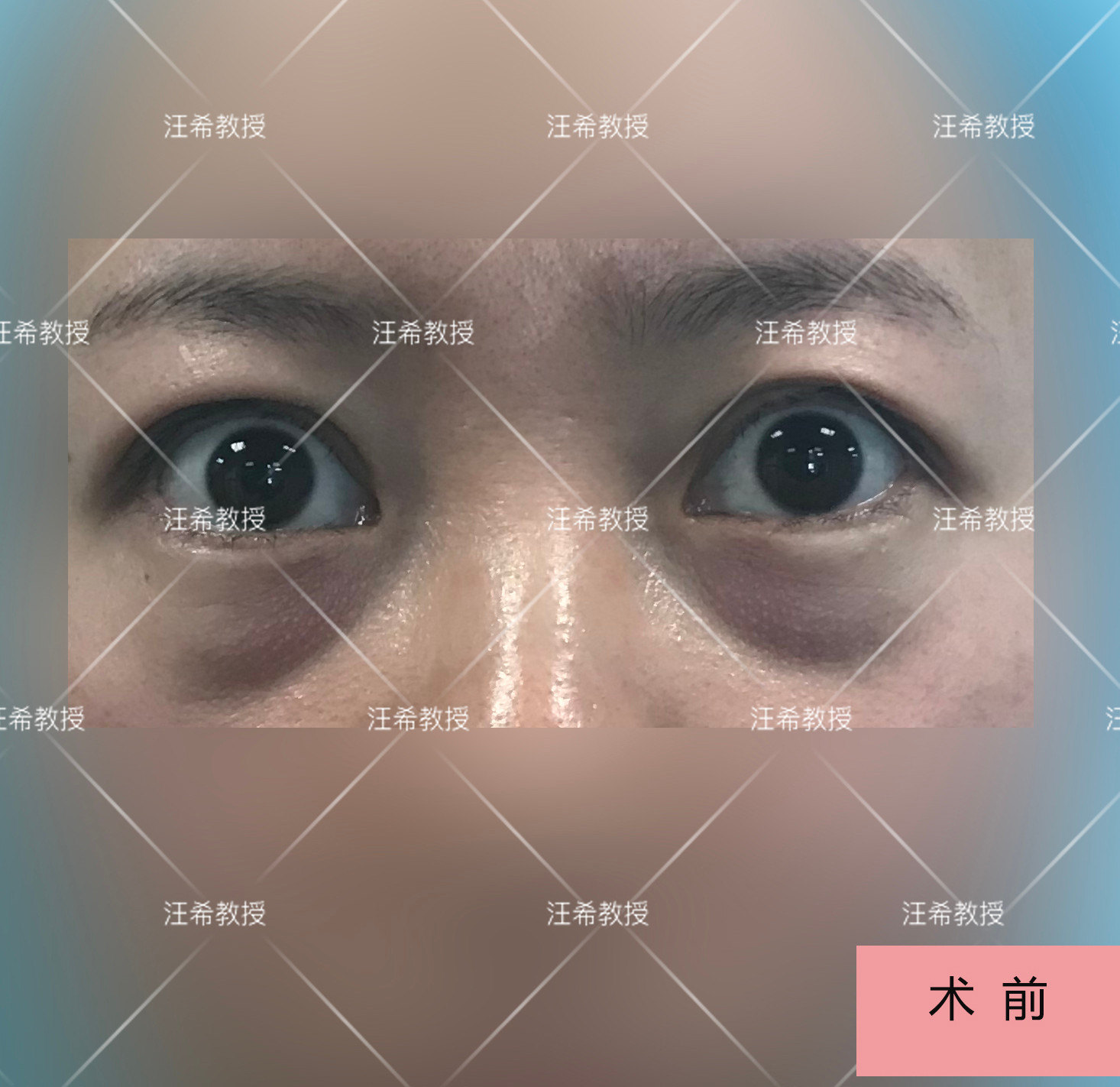 眶隔脂肪释放术案例分享 - 好大夫在线