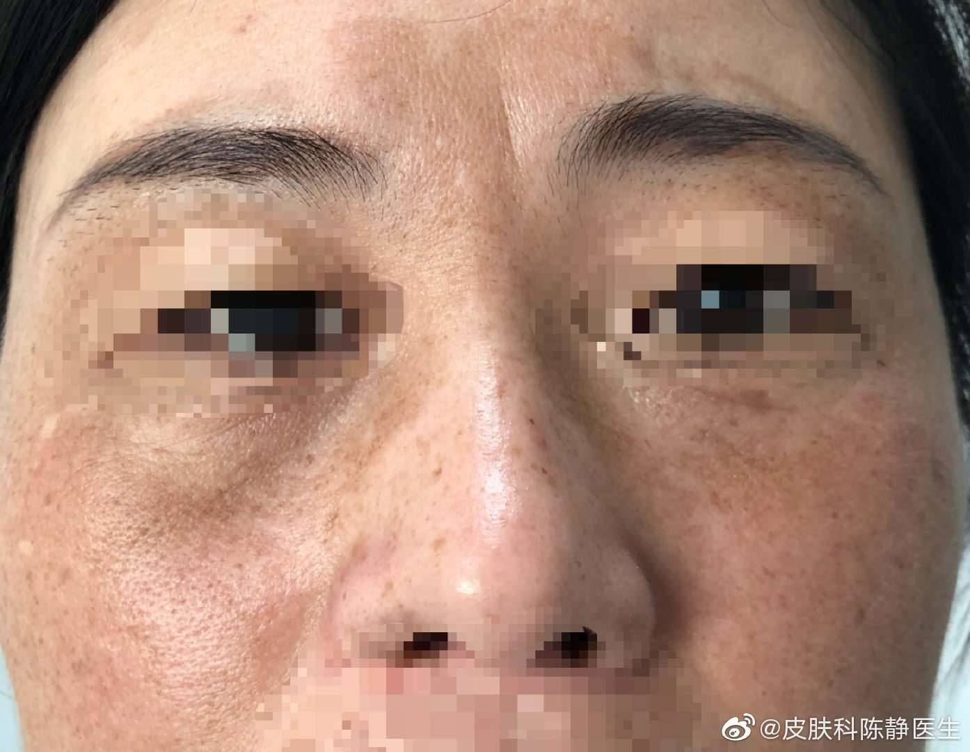 黄褐斑_黄褐斑治疗方式 - 好大夫在线