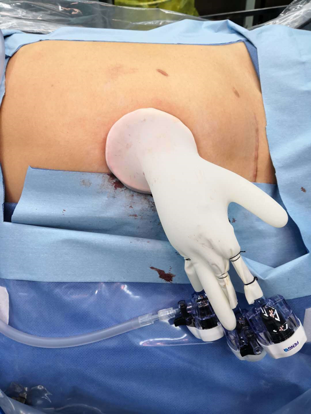 单孔腹腔镜肾上腺肿瘤微创切除兼顾控瘤和美容