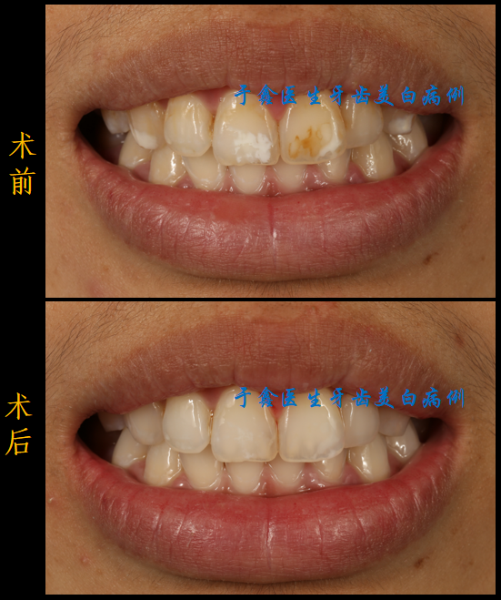 氟斑牙冷光美白前后图图片