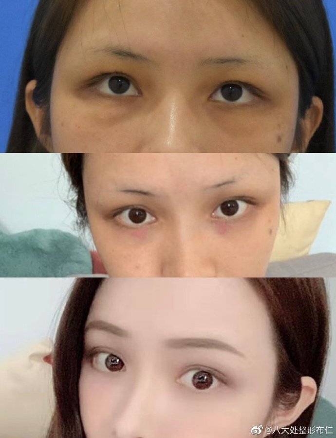 6, 泪沟:泪沟一般是先天性的,眼部皮肤较薄的人常常会比一般人更明显.