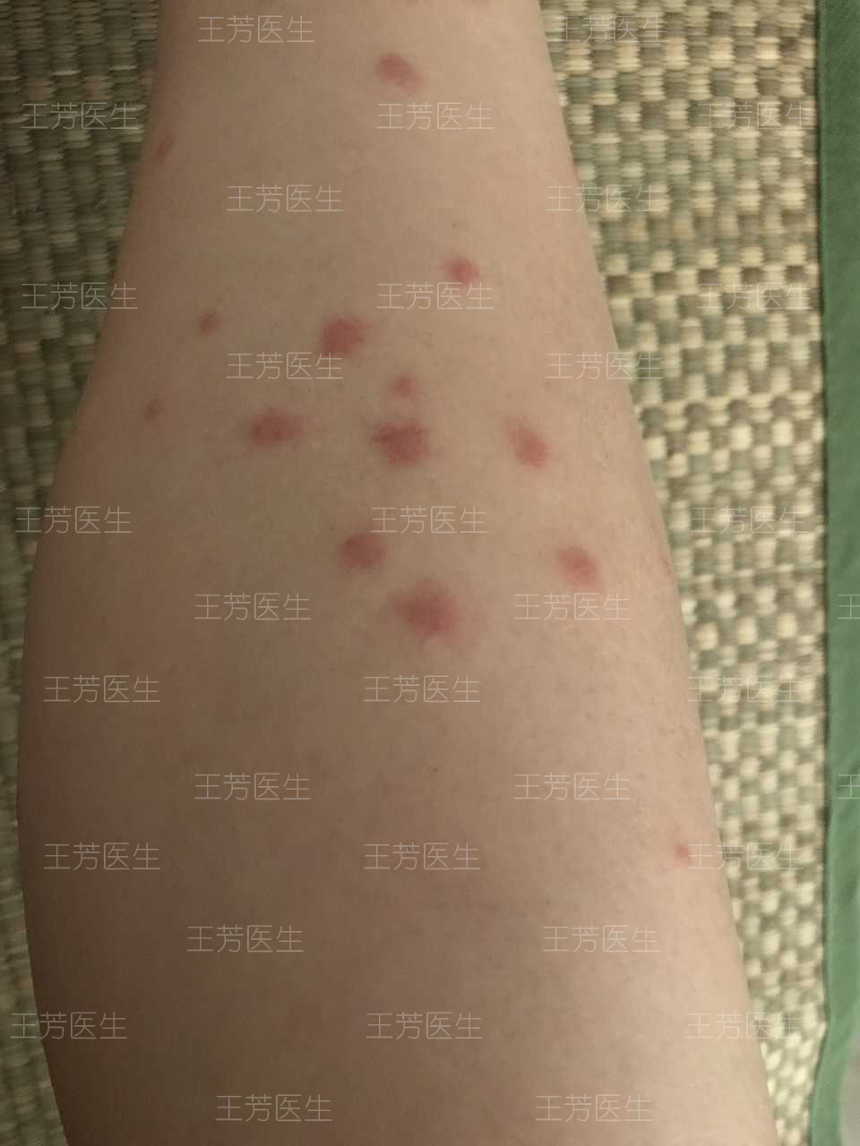虫咬性荨麻疹怎么解决图片