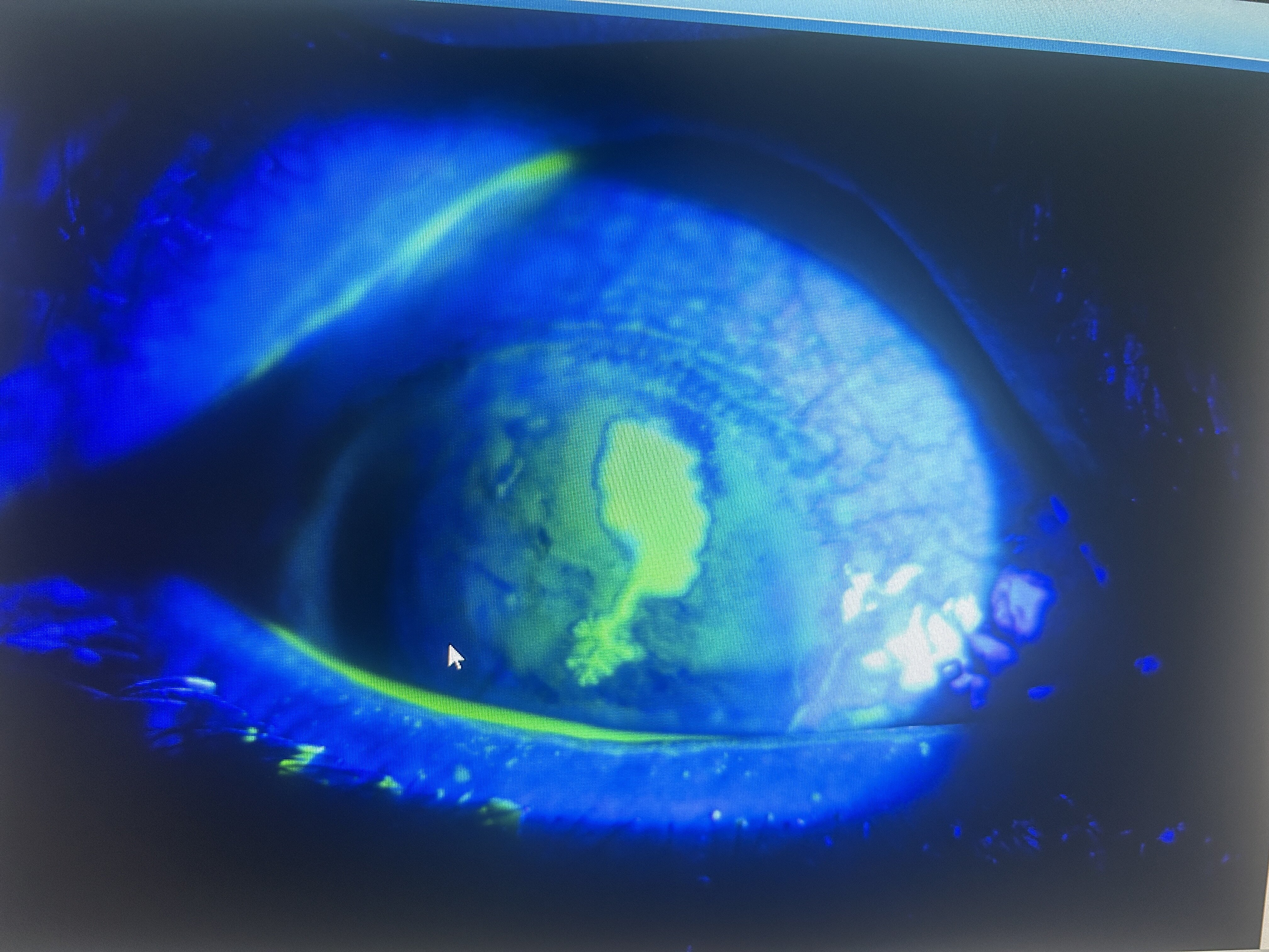 一例典型的病毒性角膜溃疡的患者