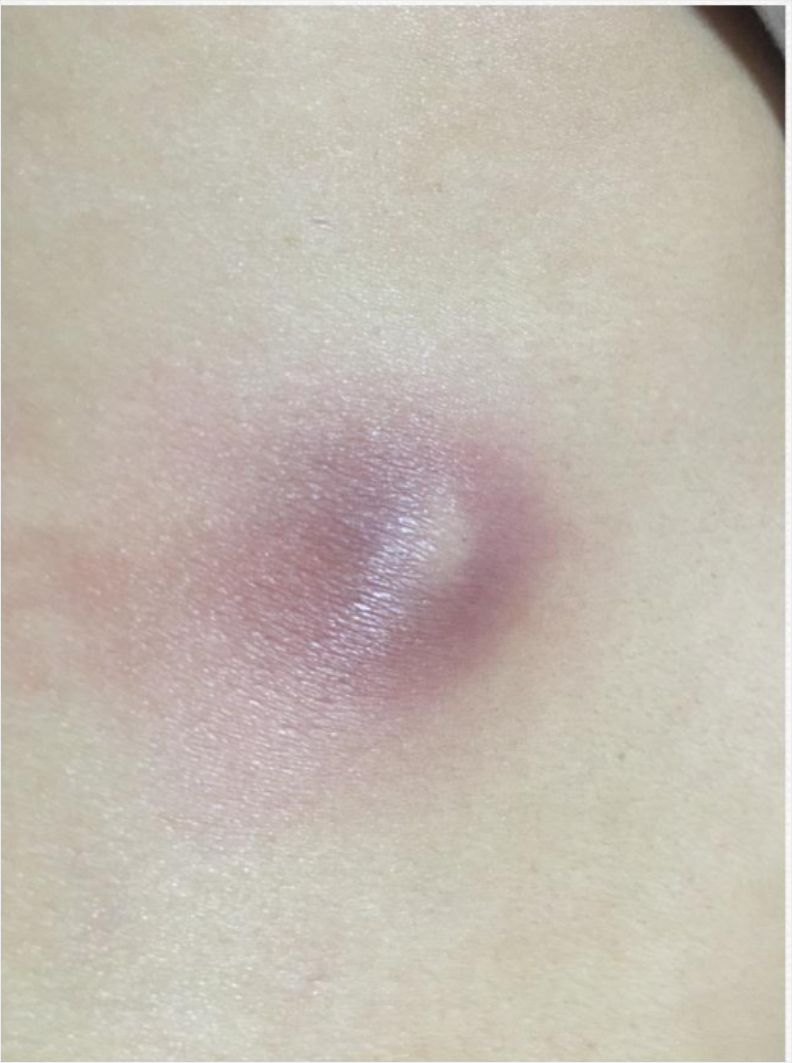 皮肤里的"小炸弹"