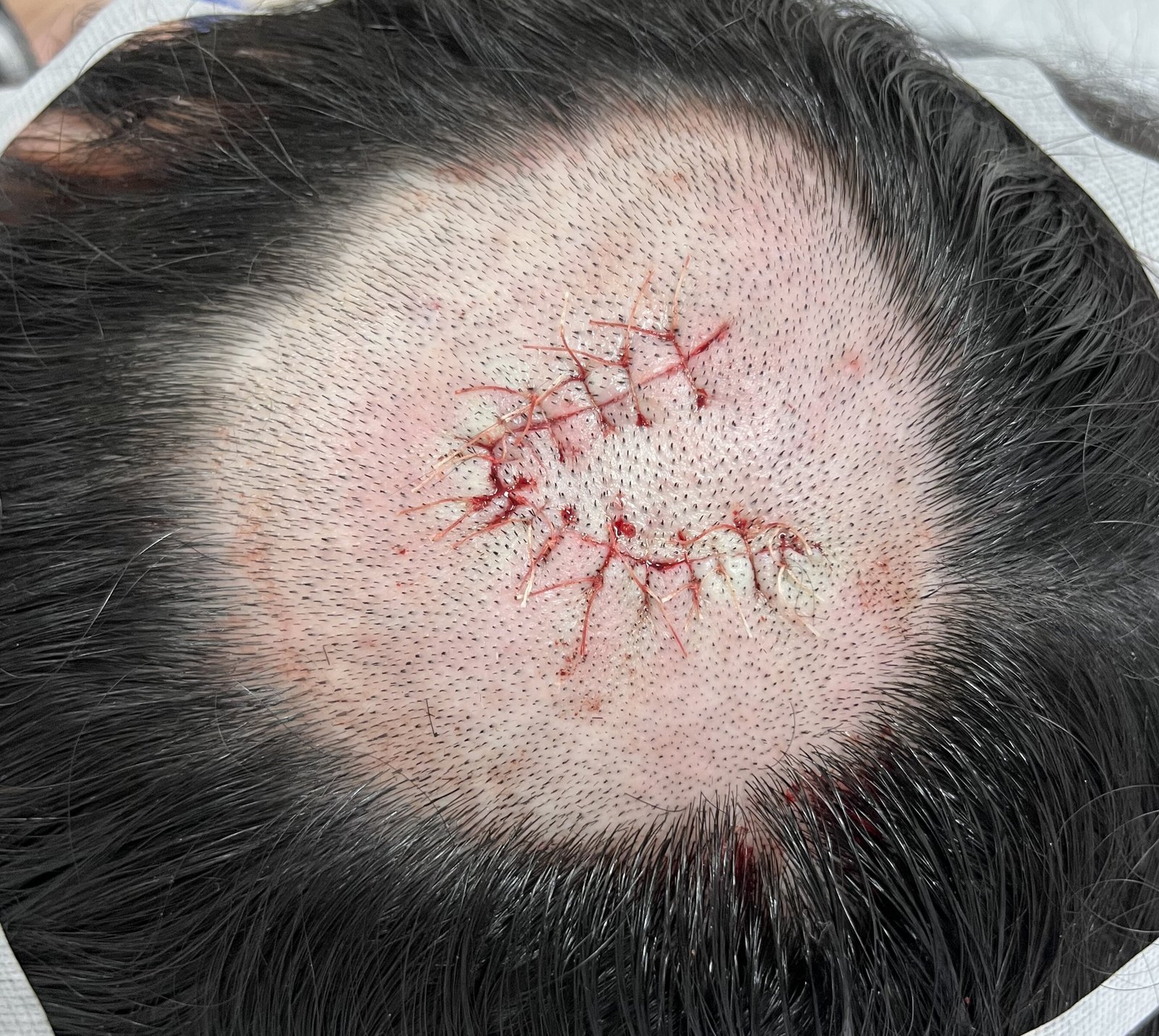 头皮皮脂腺痣一例