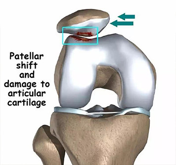 當心習慣性髕骨脫位惹得禍_髕骨脫位_發病原因_症狀表現_檢查_治療