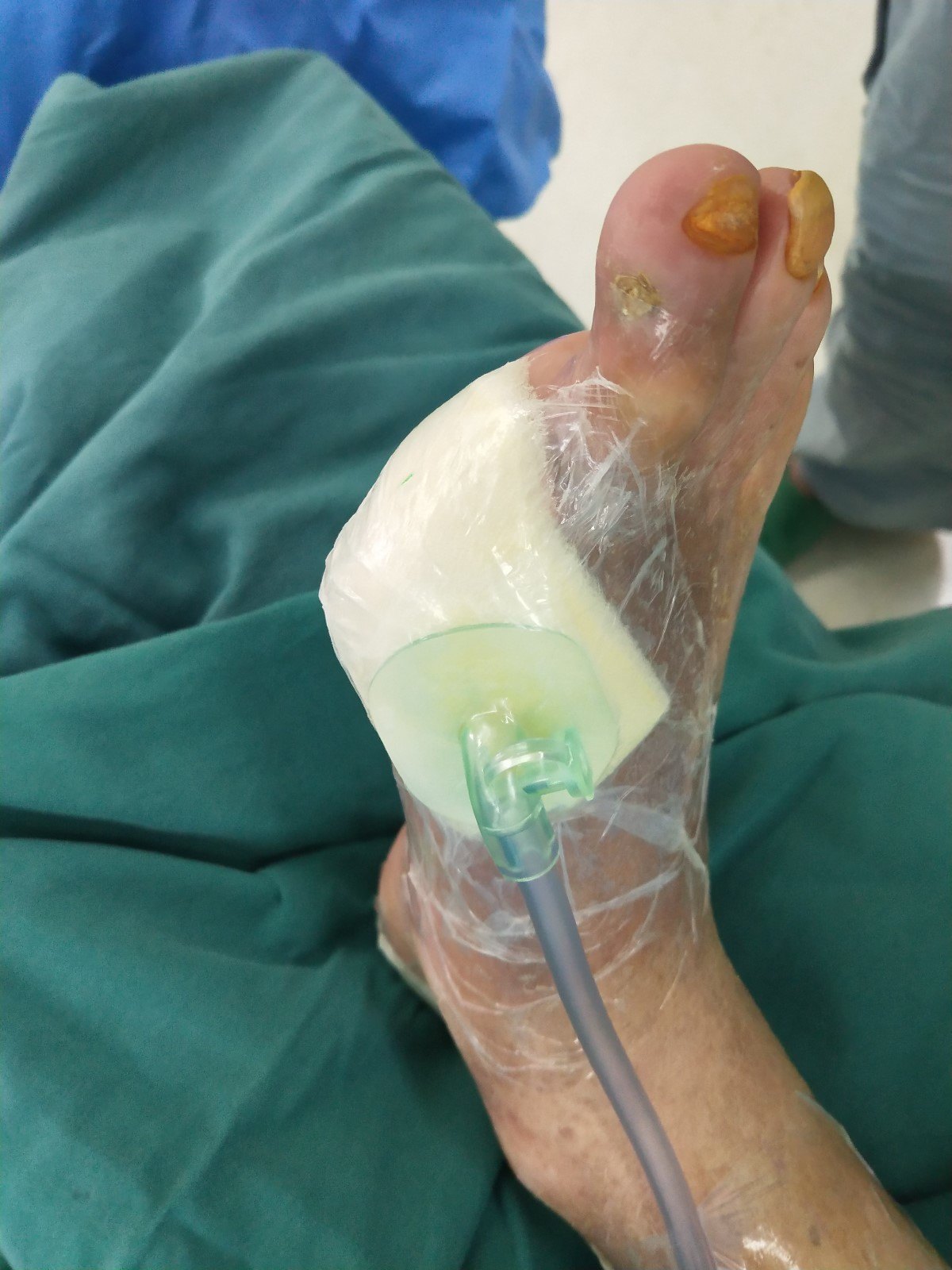 出院前换药:用生理盐水及康复新液清洁伤口 普朗特湿敷10分钟 生长