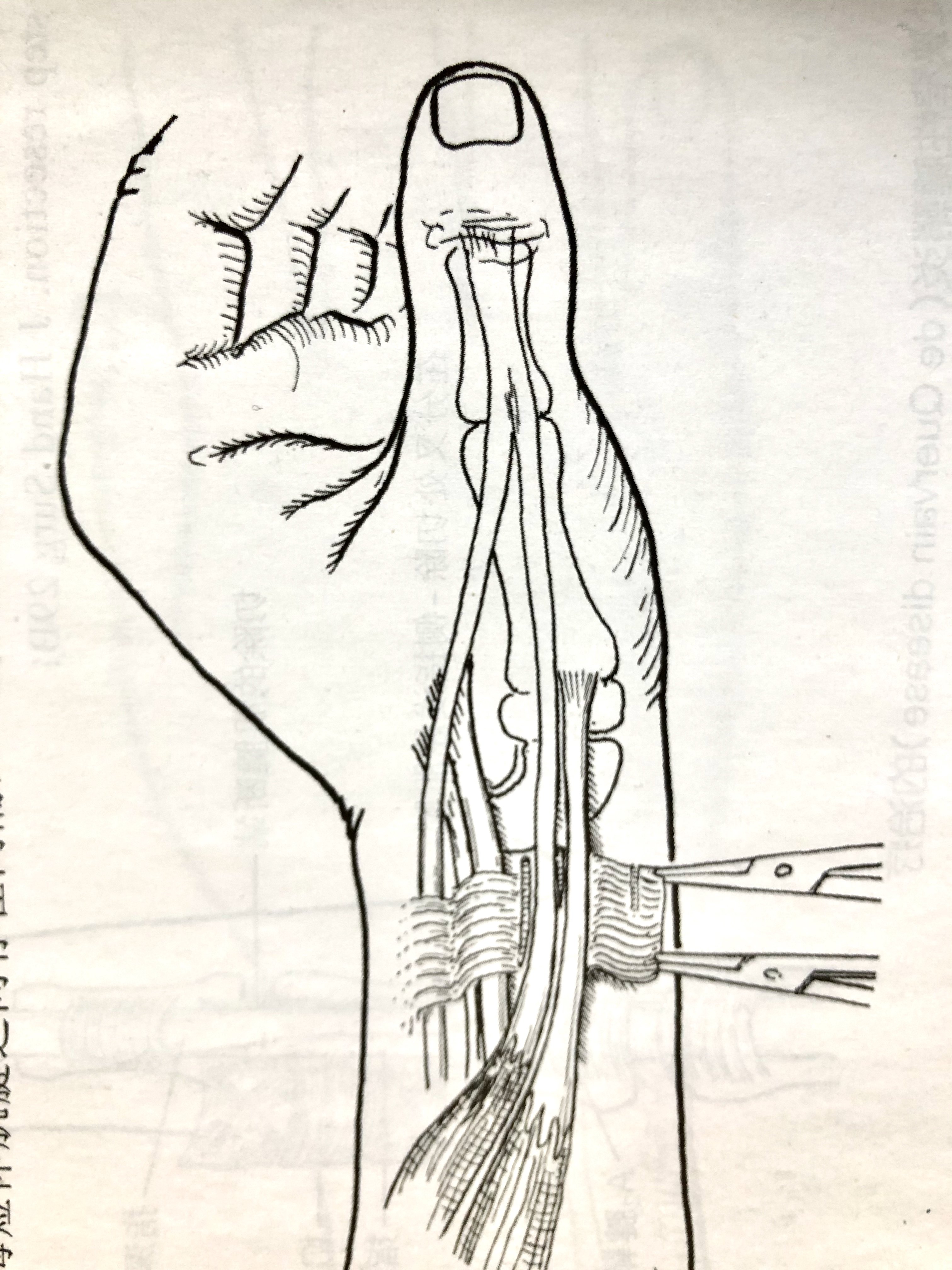 拇指腱鞘狭窄手术图解图片
