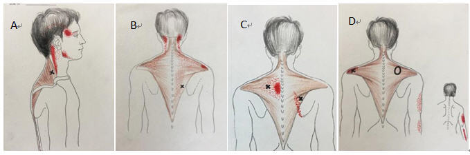 肩颈筋膜炎的症状图图片